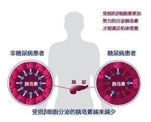 胰島細(xì)胞薄膜化有望根治糖尿病